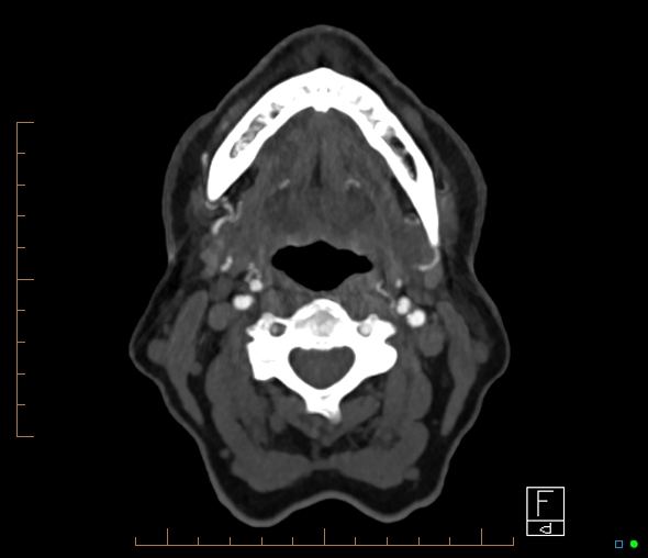Brachiocephalic trunk stenosis (Radiopaedia 87242-103519 A 86).jpg