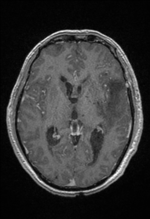 Brain abscess with ventriculitis (Radiopaedia 85703-101495 Axial T1 C+ 91).jpg