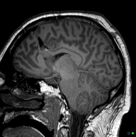 Brain death on MRI and CT angiography (Radiopaedia 42560-45689 Sagittal T1 32).jpg