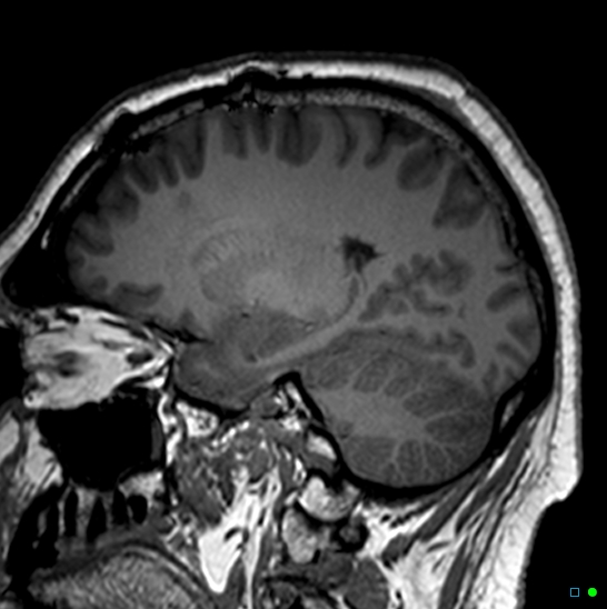Brain death on MRI and CT angiography (Radiopaedia 42560-45689 Sagittal T1 46).jpg