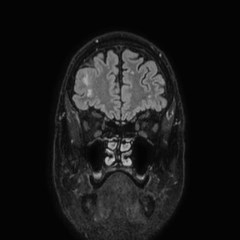 Brain metastases from lung cancer (Radiopaedia 83839-99028 Coronal FLAIR 12).jpg