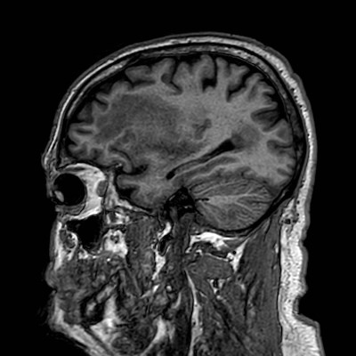 Brain metastases from lung cancer (Radiopaedia 83839-99028 Sagittal T1 34).jpg