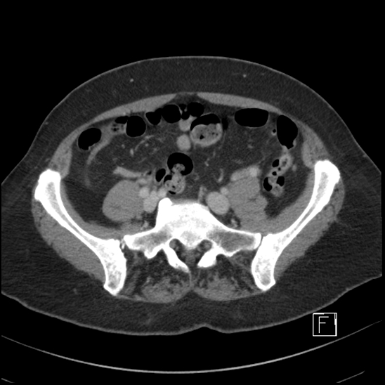 File:Breast metastases from renal cell cancer (Radiopaedia 79220-92225 C 81).jpg