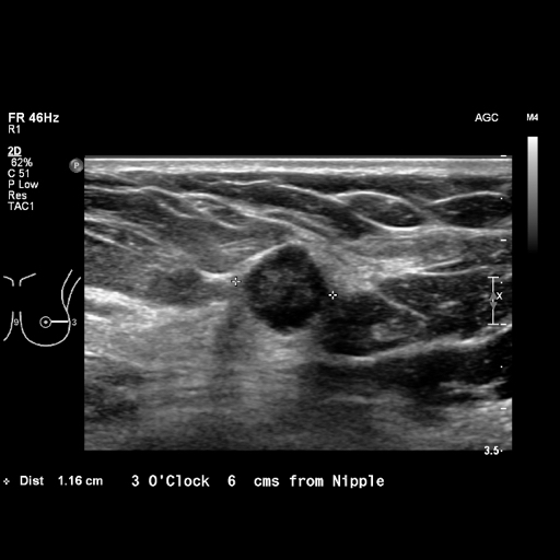 File:Breast metastases from renal cell cancer (Radiopaedia 79220-92226 Left breast US 11).jpeg