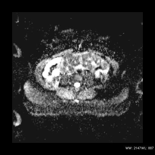 File:Broad ligament fibroid (Radiopaedia 49135-54241 Axial ADC 2).jpg