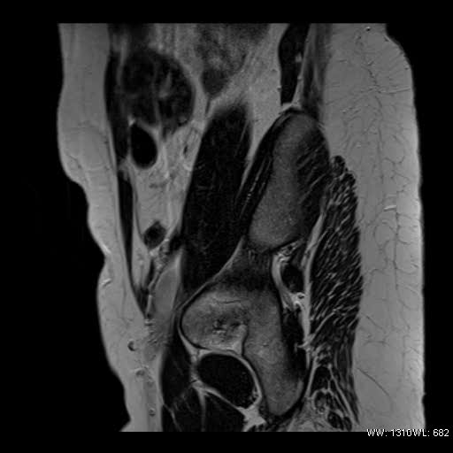 File:Broad ligament fibroid (Radiopaedia 49135-54241 Sagittal T2 24).jpg