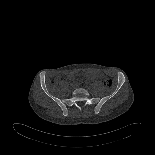 Brodie abscess- femoral neck (Radiopaedia 53862-59966 Axial bone window 28).jpg