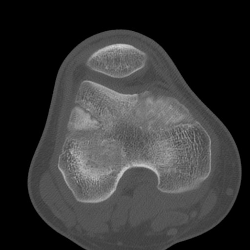 Brodie abscess of the tibia (Radiopaedia 58984-66250 Axial bone window 36).jpg