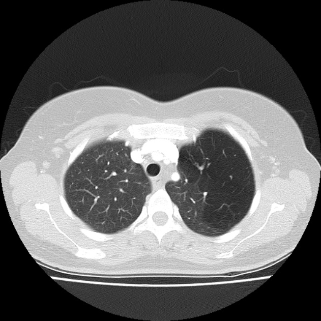 Bronchial atresia (Radiopaedia 22965-22992 Axial lung window 40).jpg