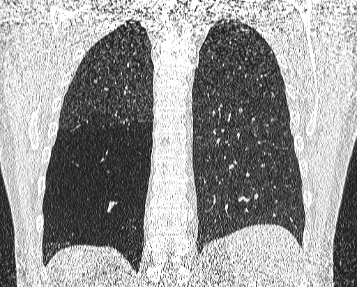 File:Bronchial atresia (Radiopaedia 58271-65417 Coronal lung window 45).jpg