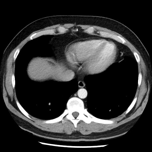 Bronchial carcinoid tumor (Radiopaedia 67377-76764 A 47).jpg