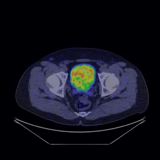 Bronchial carcinoid tumor (Radiopaedia 67377-76765 68Ga-DOTATATE PET-CT 71).jpg