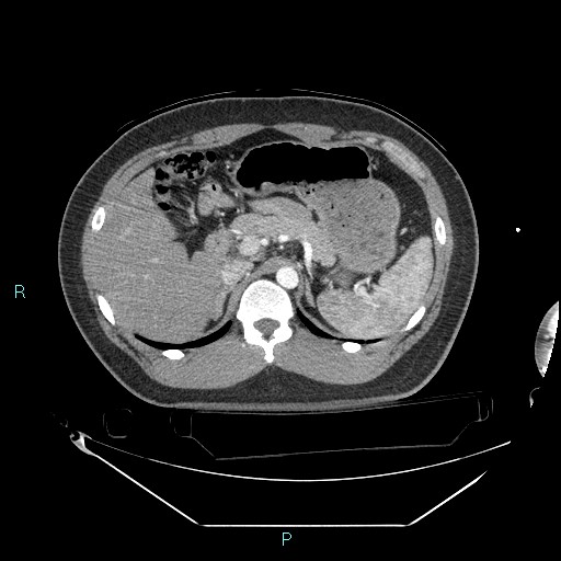 Bronchial carcinoid tumor (Radiopaedia 78272-90870 B 124).jpg