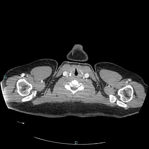 Bronchial carcinoid tumor (Radiopaedia 78272-90875 A 1).jpg