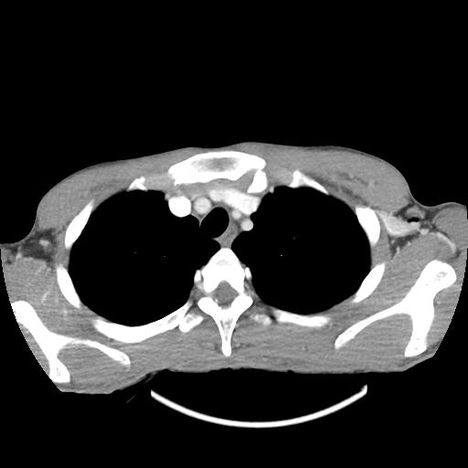 Bronchial carcinoid tumor causing right lower lobe collapse (Radiopaedia 83495-98594 A 6).jpg