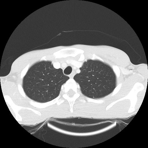 Bronchial carcinoid tumor causing right lower lobe collapse (Radiopaedia 83495-98594 Axial lung window 6).jpg