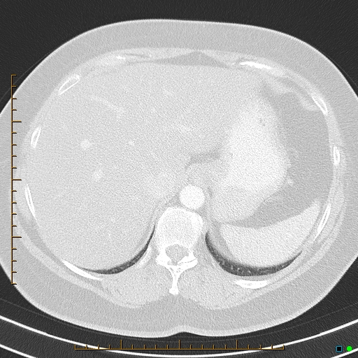 Bronchial diverticula (Radiopaedia 79512-92675 Axial lung window 45).jpg