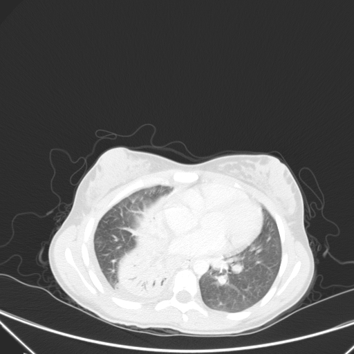 Bronchial mucoepidermoid carcinoma (Radiopaedia 57023-63895 Axial lung window 65).jpg