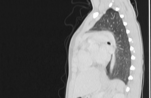 Bronchial mucoepidermoid carcinoma (Radiopaedia 57023-63895 Sagittal lung window 115).jpg