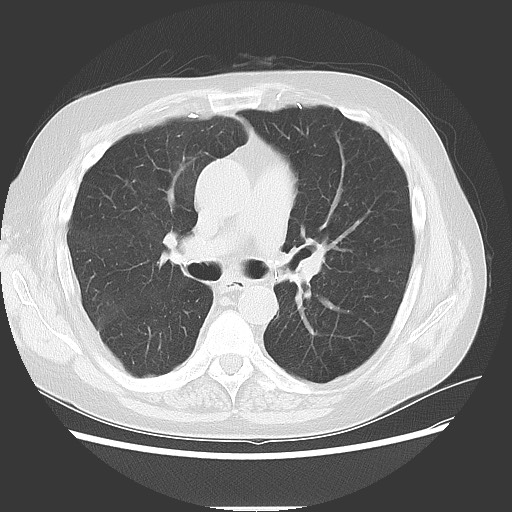 Bronchial stenosis - lung transplant (Radiopaedia 73133-83848 Axial lung window 29).jpg