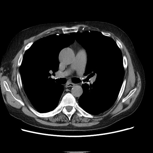 Bronchial stenosis - lung transplant (Radiopaedia 73133-83848 Axial non-contrast 29).jpg