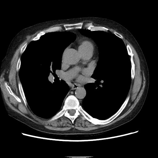 Bronchial stenosis - lung transplant (Radiopaedia 73133-83848 Axial non-contrast 34).jpg