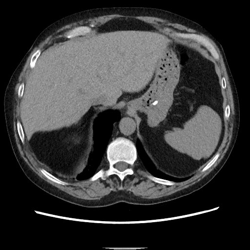Bronchial stenosis - lung transplant (Radiopaedia 73133-83848 Axial non-contrast 54).jpg