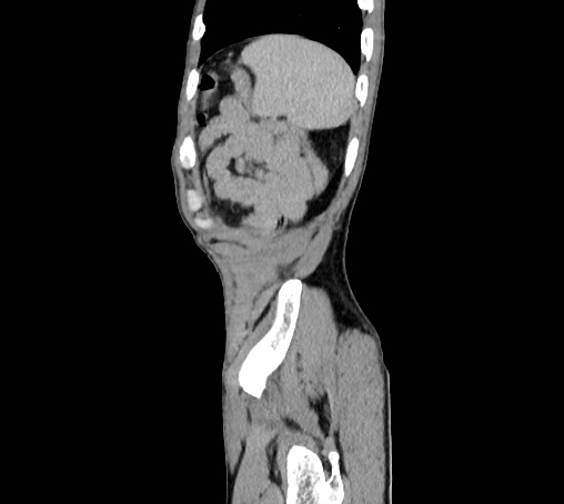 File:Bronchiectasis in Crohn disease (Radiopaedia 60311-67977 D 108).jpg