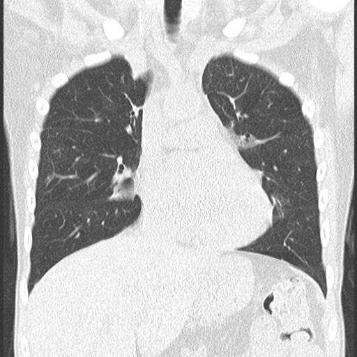 File:Bronchiolotis obliterans (Radiopaedia 73769-84575 Coronal lung window 17).jpg