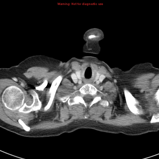 File:Bronchoalveolar carcinoma (BAC) (Radiopaedia 13436-13392 B 1).jpg