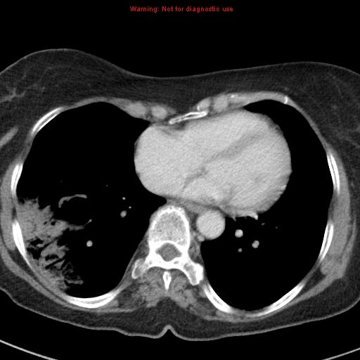 File:Bronchoalveolar carcinoma (BAC) (Radiopaedia 13436-13392 B 36).jpg