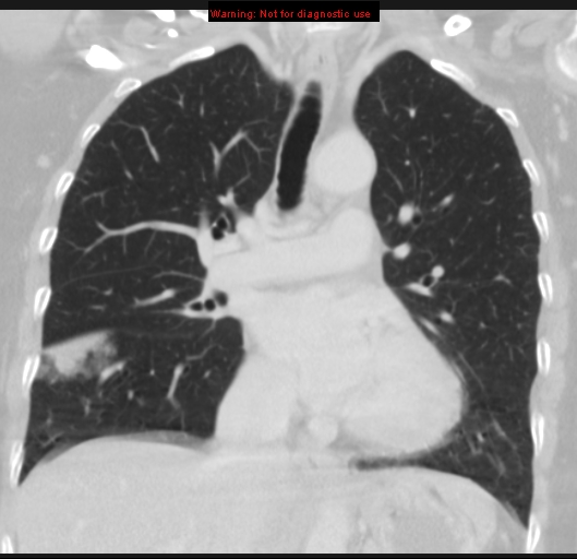 Bronchoalveolar carcinoma (BAC) (Radiopaedia 13436-13392 Coronal lung window 28).jpg