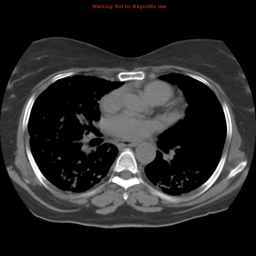 Bronchoalveolar carcinoma (Radiopaedia 13224-13233 Axial non-contrast 25).jpg