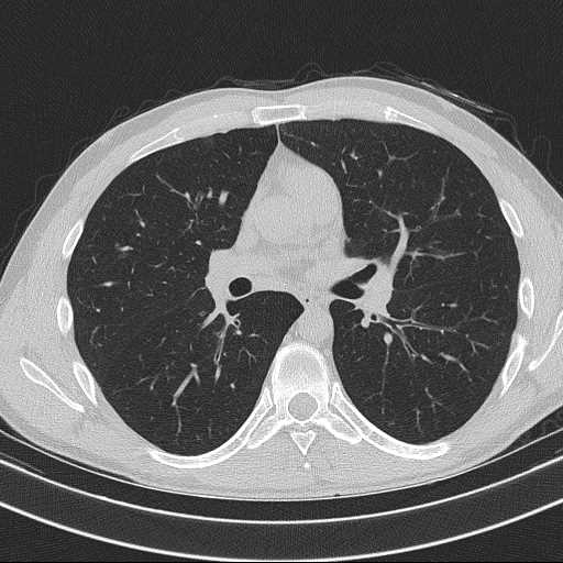 Bronchocele (Radiopaedia 60676-68429 Axial lung window 34).jpg