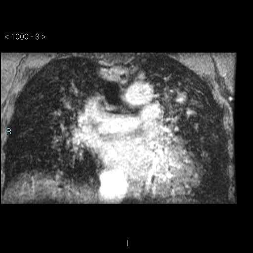 File:Bronchogenic cyst - posterior mediastinal (Radiopaedia 43885-47365 Coronal T1 C+ 2).jpg