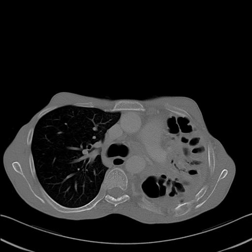 File:Bronchopleural fistula secondary to tuberculosis (Radiopaedia 20415-20322 Axial bone window 12).jpg
