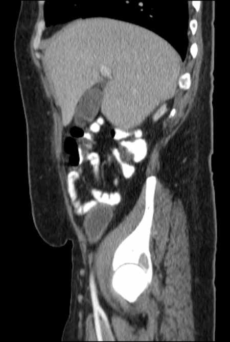 Brown tumors compressing the spinal cord (Radiopaedia 68442-77988 F 16).jpg