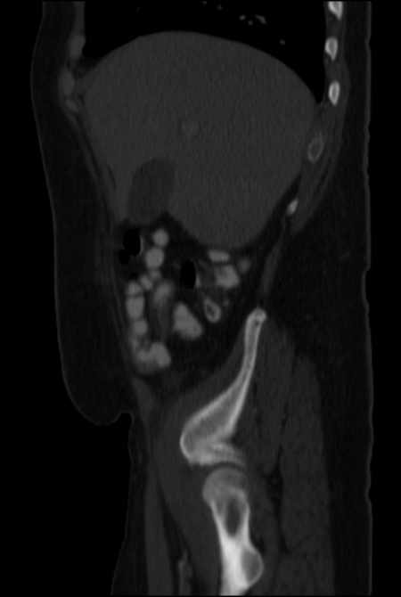 Brown tumors compressing the spinal cord (Radiopaedia 68442-77988 H 14).jpg
