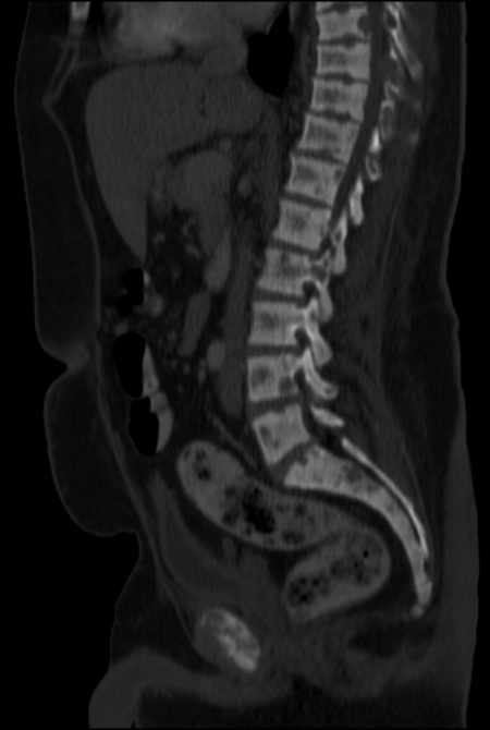 Brown tumors compressing the spinal cord (Radiopaedia 68442-77988 H 28).jpg