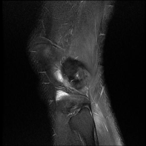 File:Bucket handle tear - medial meniscus (Radiopaedia 69245-79026 Sagittal PD fat sat 1).jpg