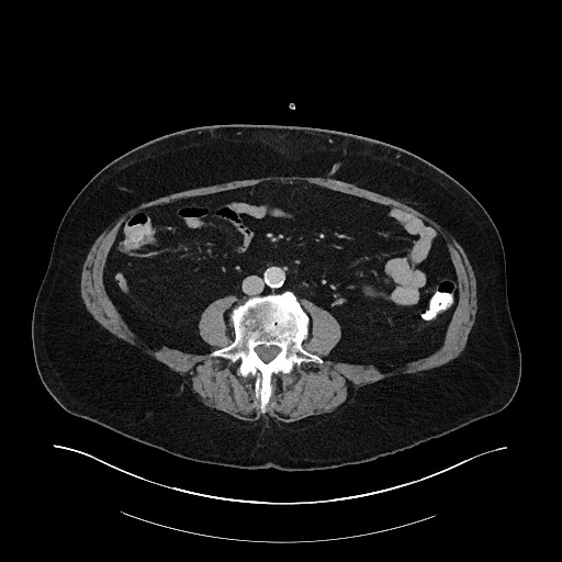 Buried bumper syndrome - gastrostomy tube (Radiopaedia 63843-72575 A 55).jpg