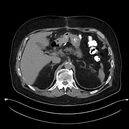 File:Buried bumper syndrome - gastrostomy tube (Radiopaedia 63843-72577 Axial Inject 26).jpg