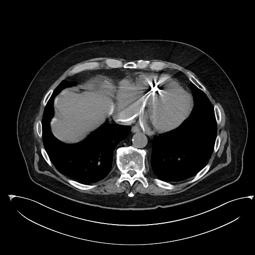 File:Buried bumper syndrome - gastrostomy tube (Radiopaedia 63843-72577 Axial Inject 6).jpg