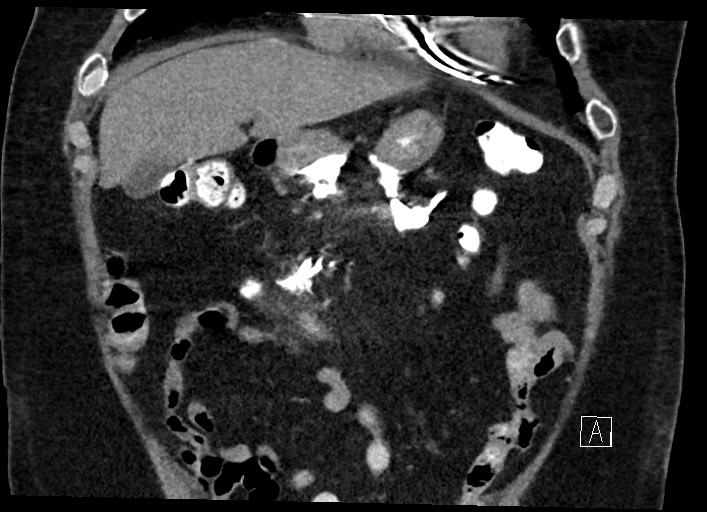 Buried bumper syndrome - gastrostomy tube (Radiopaedia 63843-72577 Coronal Inject 41).jpg