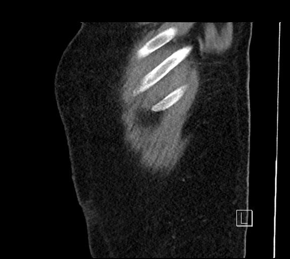 Buried bumper syndrome - gastrostomy tube (Radiopaedia 63843-72577 Sagittal Inject 116).jpg