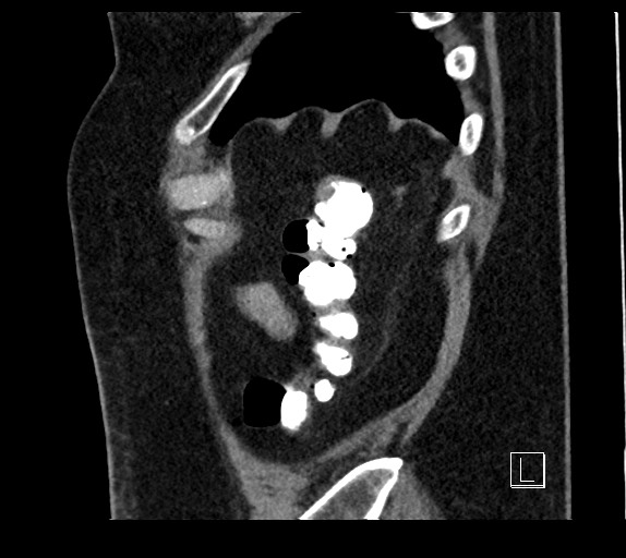 Buried bumper syndrome - gastrostomy tube (Radiopaedia 63843-72577 Sagittal Inject 13).jpg