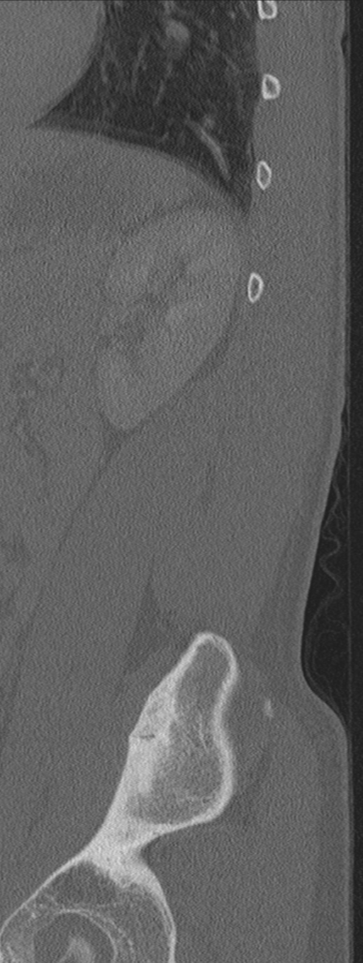 Burst fracture - T12 with conus compression (Radiopaedia 56825-63647 Sagittal bone window 7).png