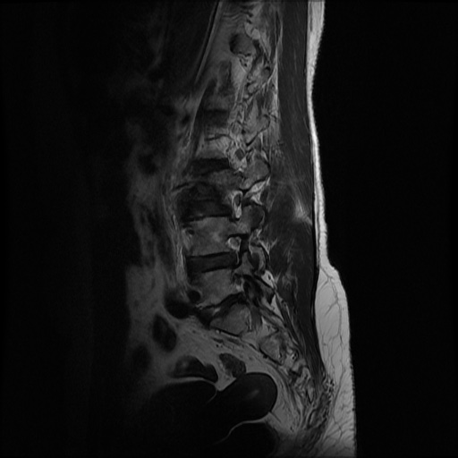 File:Burst fracture - lumbar spine (Radiopaedia 72877-83541 Sagittal T2 9).jpg