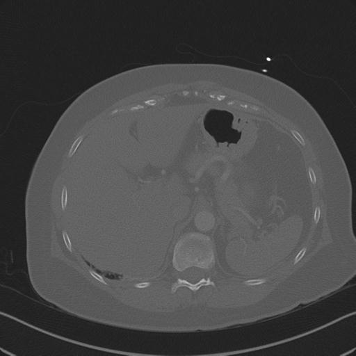 Burst fracture - thoracic spine (Radiopaedia 30238-30865 Axial bone window 86).jpg