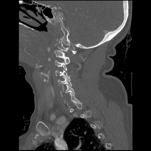File:C1 anterior arch (plough) fracture - type 1 (Radiopaedia 76181-87720 Sagittal bone window 71).jpg